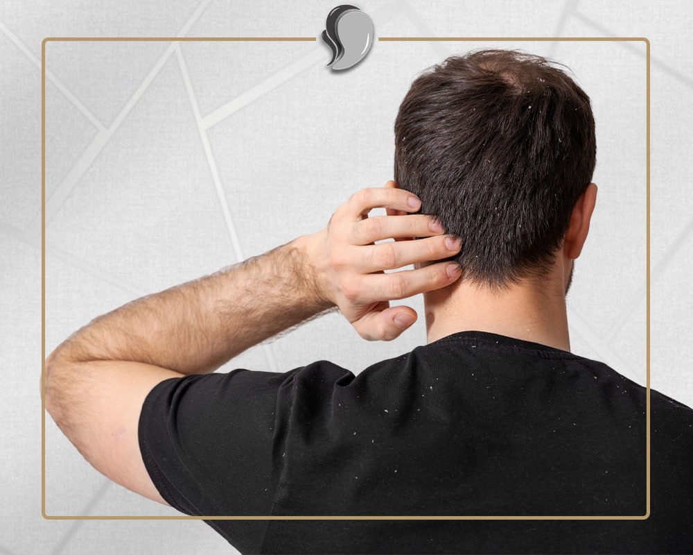 Hair Transplant – Biot Clinic