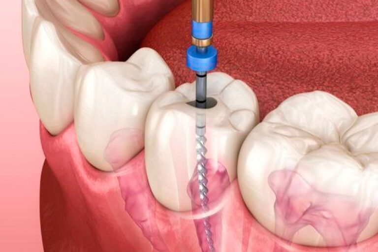 Root Canal Treatment