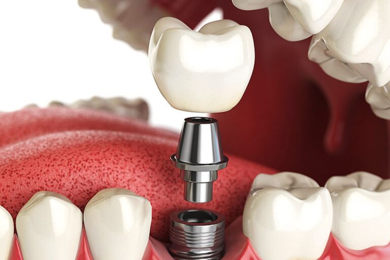 Dental treatment at Biot Clinic Istanbul