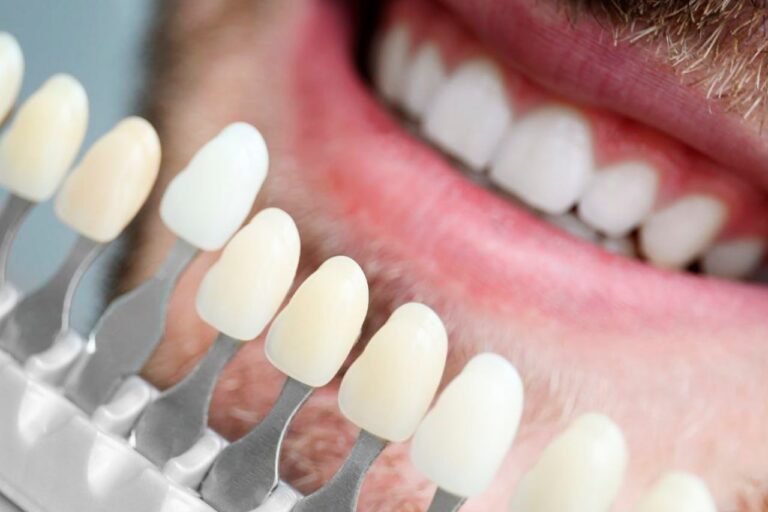 Dental Veneers