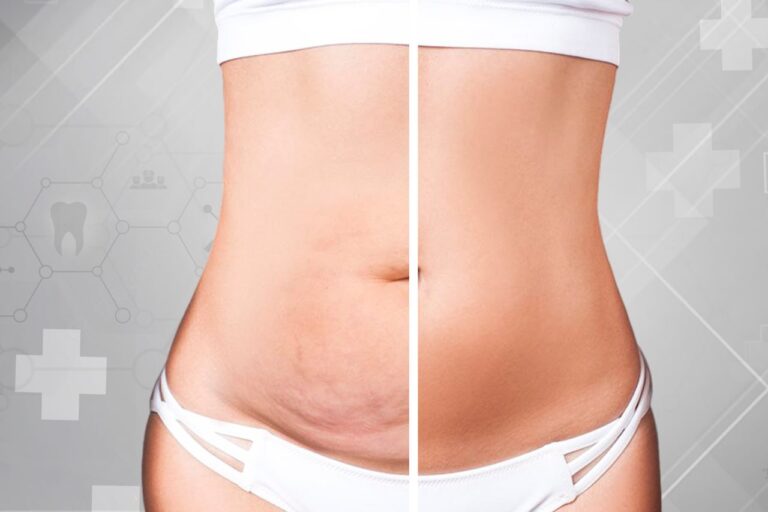 Tummy Tuck