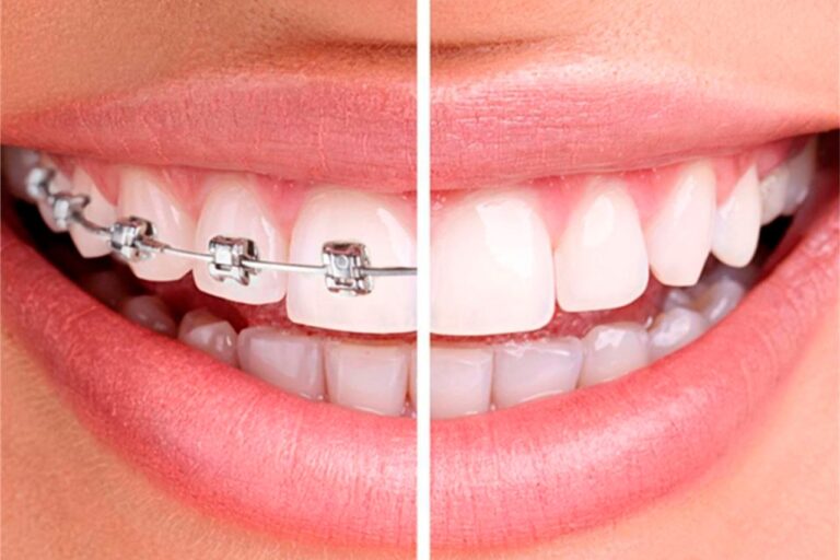 Orthodontic Treatment