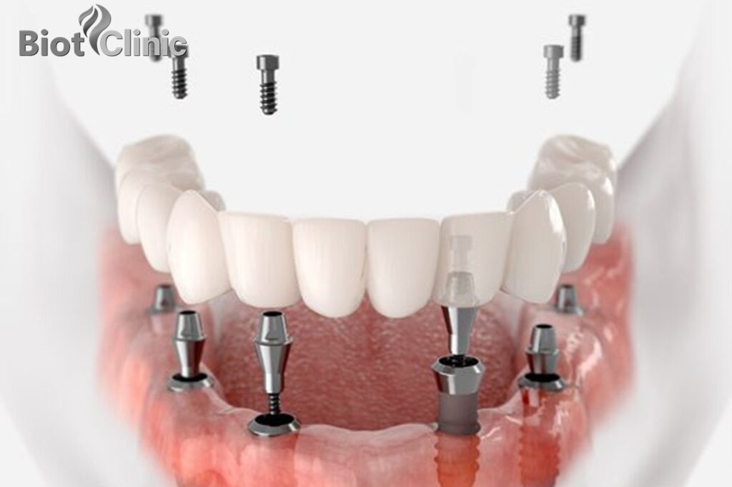 Biot Clinic-Implants